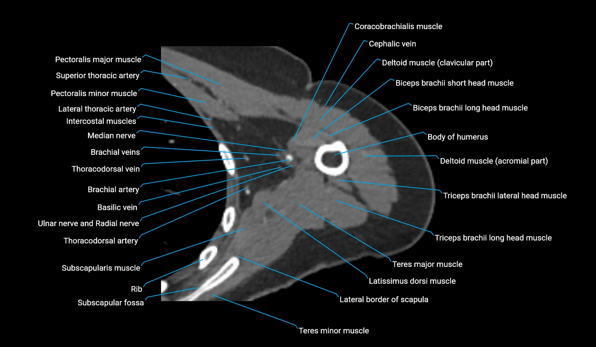 CT upper arm axial  cross sectional anatomy labelled radiology image -00152.webp